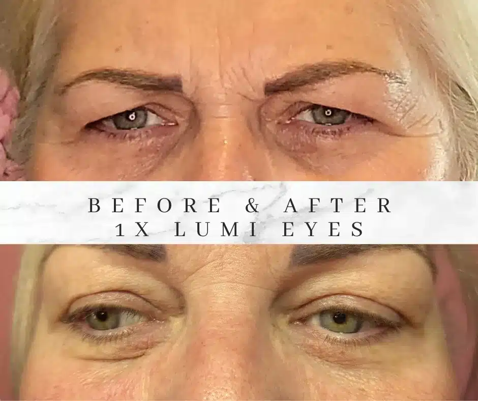 lumi eyes results