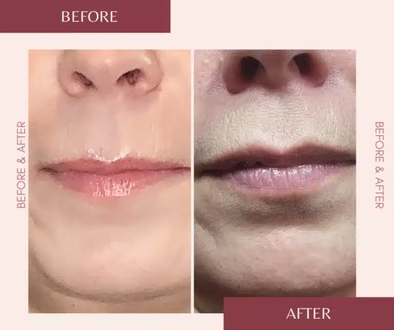 lip flip results