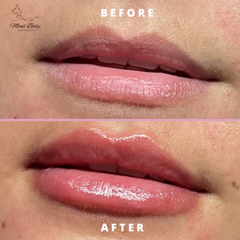 Lip Filler